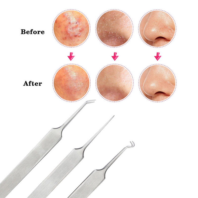 Acne Blackhead Tweezer Remover Clip Comedone Blemish Pimple Extractor Nipper Face Cleaner Tool - Oblique