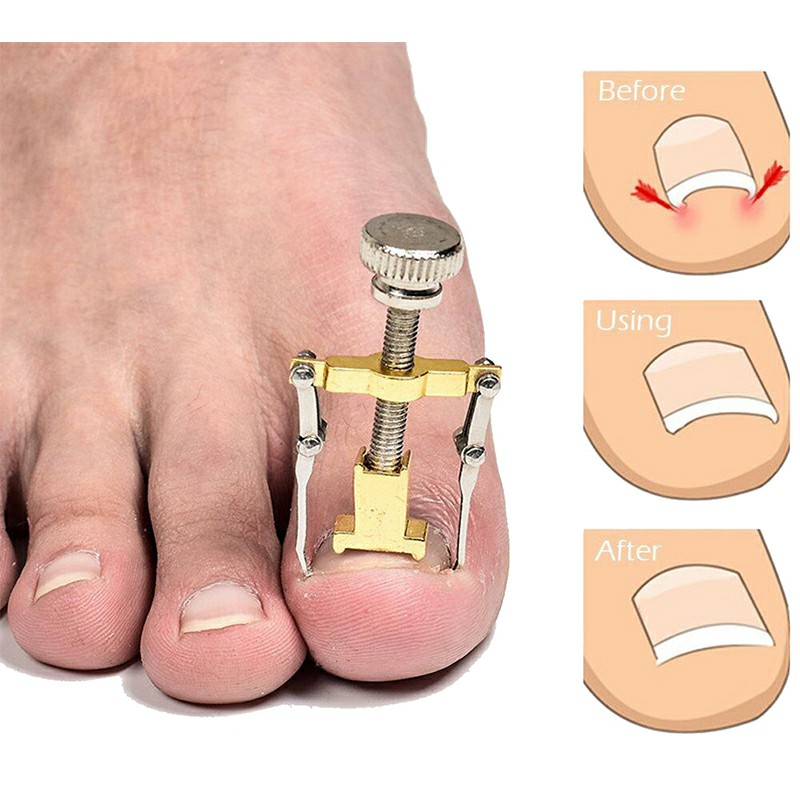 Ingrown Toenail Manicure Pedicure Foot Care Correction Brace Tool Toe Clipper Foot Nails Care Tool